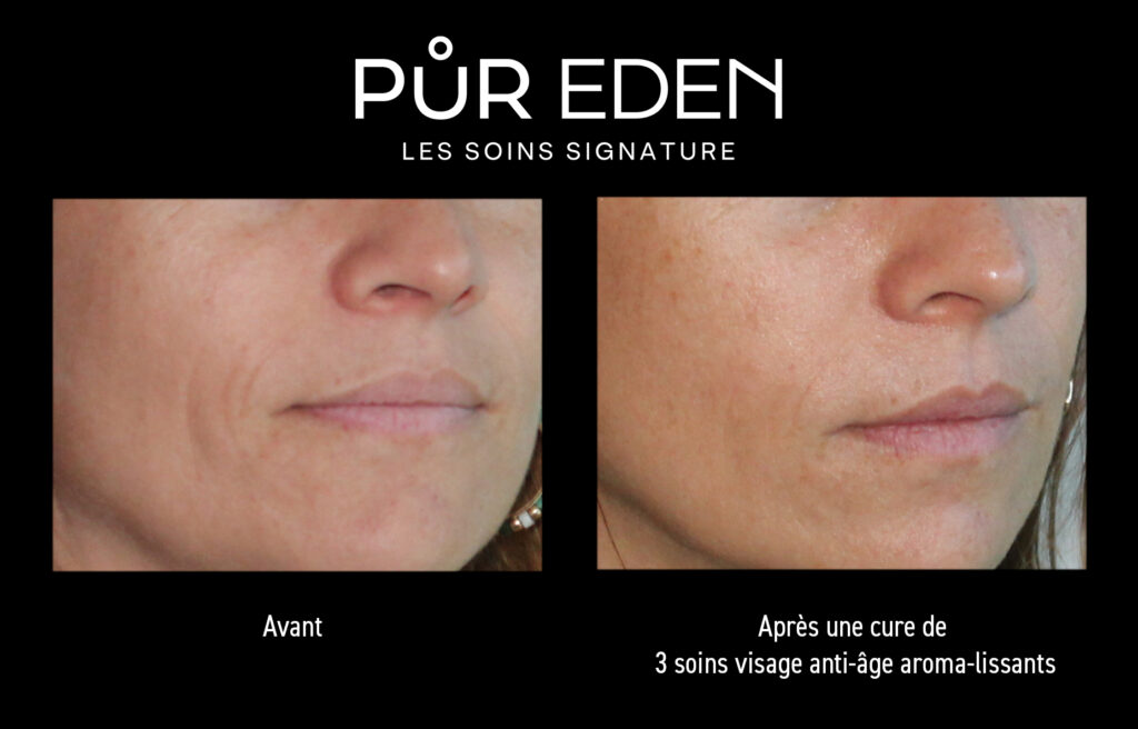 AVANT APRES CURE 3 SOINS AA